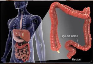 سرطان روده بزرگ (colon یا کولون) و دلایل آن
