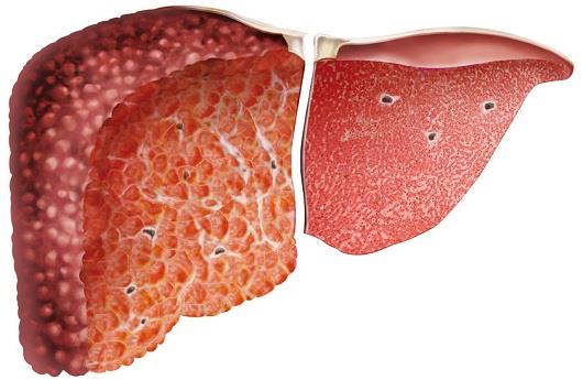 علل و علائم بیماری سیروز صفراوی اولیه
