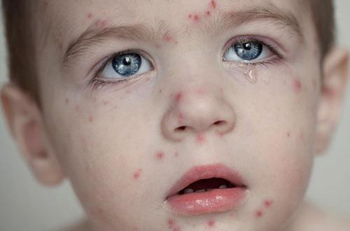 Chickenpox
